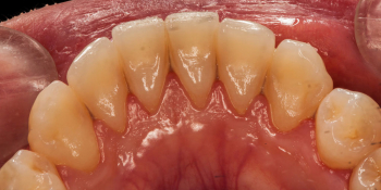 Результат профессиональной чистки зубов фото до лечения