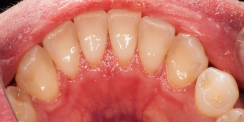Результат профессиональной чистки зубов фото после лечения