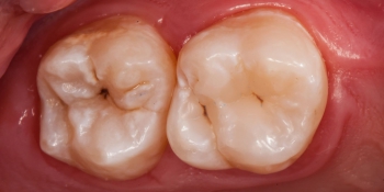 Результат лечения кариеса, реставрация жевательного зуба фото после лечения
