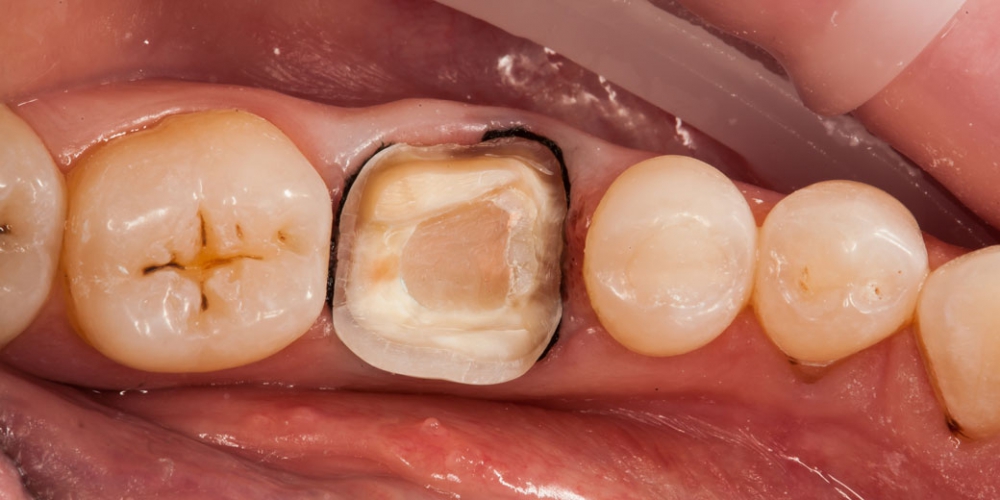 После обточки и лечения каналов Восстановление зуба цельнокерамической коронкой смоделированной в 3D