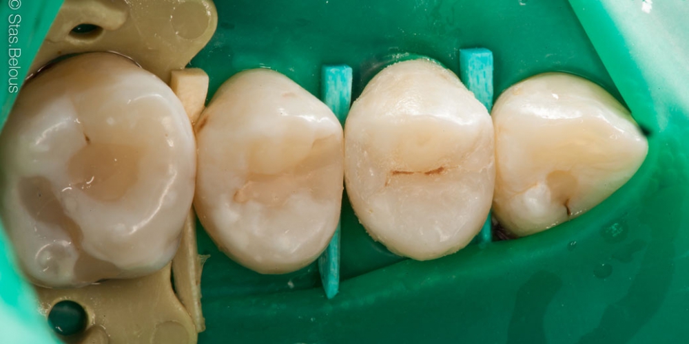  Скрытый кариес, лечение скрытых кариозных полостей на боковых поверхностях зубов