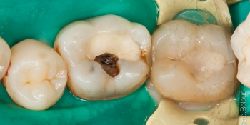 Лечение глубокого кариеса 36 и 37 зуба фото до лечения