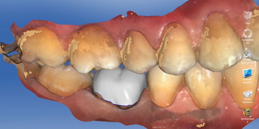 Проверка прикуса Восстановление зуба цельнокерамической коронкой смоделированной в 3D