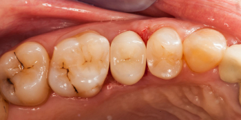 Застревание пищи между 6 и 5, а так же между 5 и 4 зубами фото после лечения