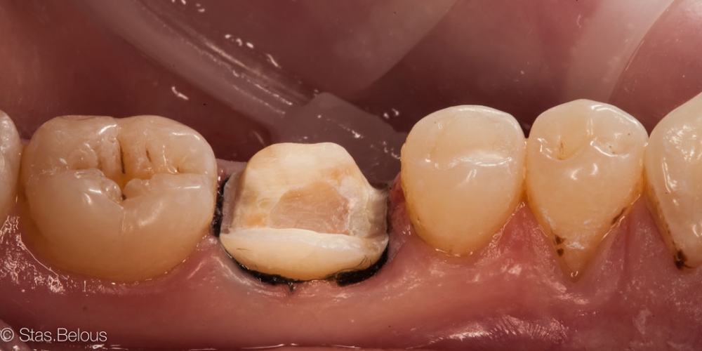 Готовим место для будущей коронки Восстановление зуба цельнокерамической коронкой смоделированной в 3D