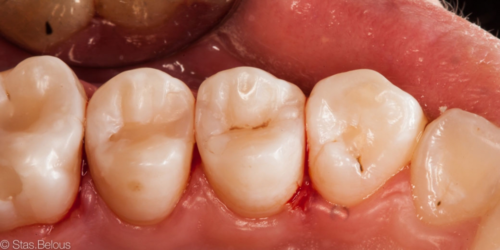 Красивое фото профессиональной реставрации зубов. Скрытый кариес, лечение скрытых кариозных полостей на боковых поверхностях зубов