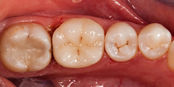 Восстановление отколотого зуба полукоронкой фото после лечения