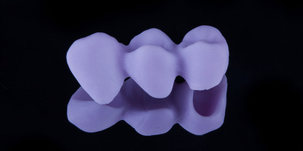  Установка мостовидного протеза из 3х единиц с опорой на 2 зуба
