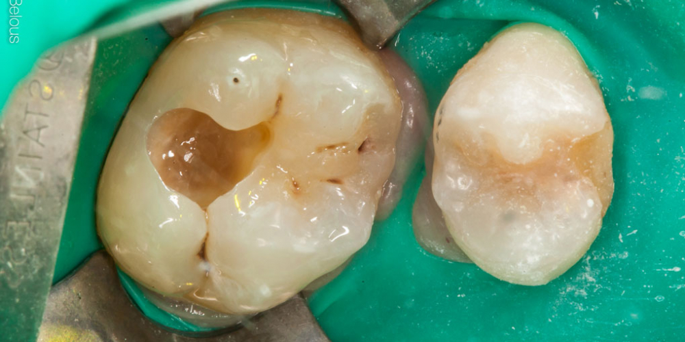  Лечение кариеса двух зубов в одно посещение