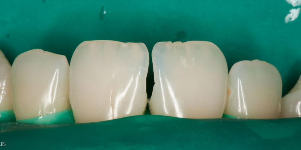  Лечение кариеса и реставрация скола на переднем зубе