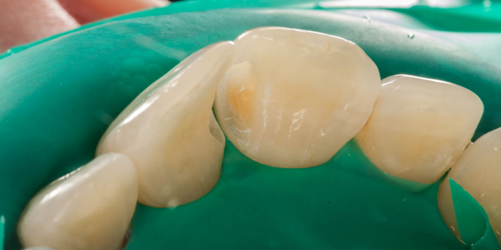  Лечение кариеса и реставрация передних зубов