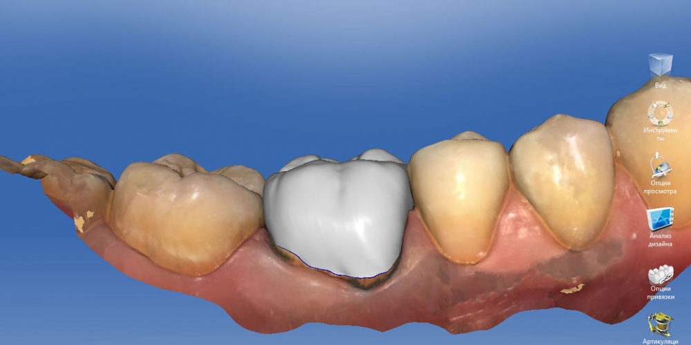  Восстановление зуба цельнокерамической коронкой смоделированной в 3D