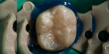 Результат лечения кариеса и реставрация жевательного зуба 38 фото после лечения