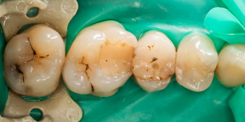 Застревание пищи между 6 и 5, а так же между 5 и 4 зубами фото до лечения