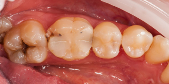 Начали лечение кариеса на одном зубе, а в итоге сделали - 2, цельнокерамическими вкладками фото до лечения