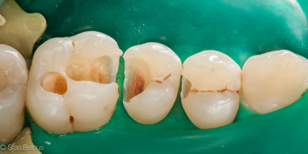 Фото в процессе лечения (удаление кариеса) Лечение кариеса (беспокоило застревание пищи между зубами)