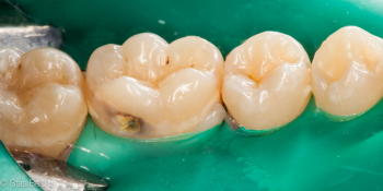Сладкоежки - будте бдительны, кариес 46 зуба фото до лечения