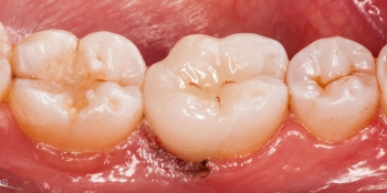 Восстановление разрушенного зуба керамической вкладкой фото после лечения