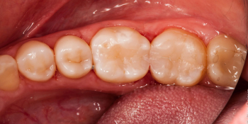 Жалоба на застревание пищи между зубами 36 и 37 фото после лечения