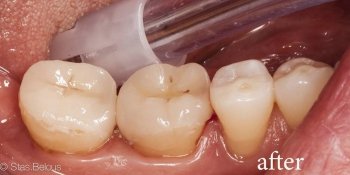 Керамические вкладки на жевательные зубы фото после лечения