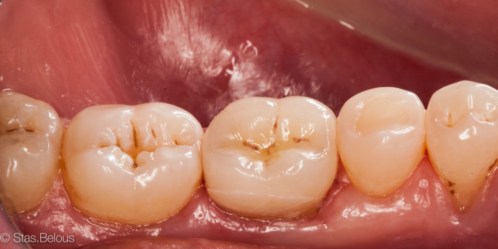 Готовая работа Восстановление зуба цельнокерамической коронкой смоделированной в 3D