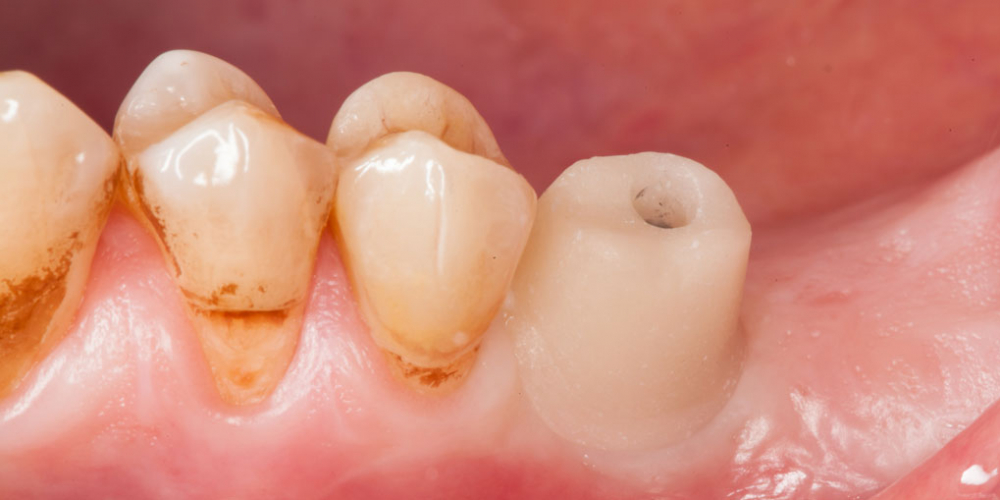 Абатмент в полости рта. Протезирование зуба после имплантации