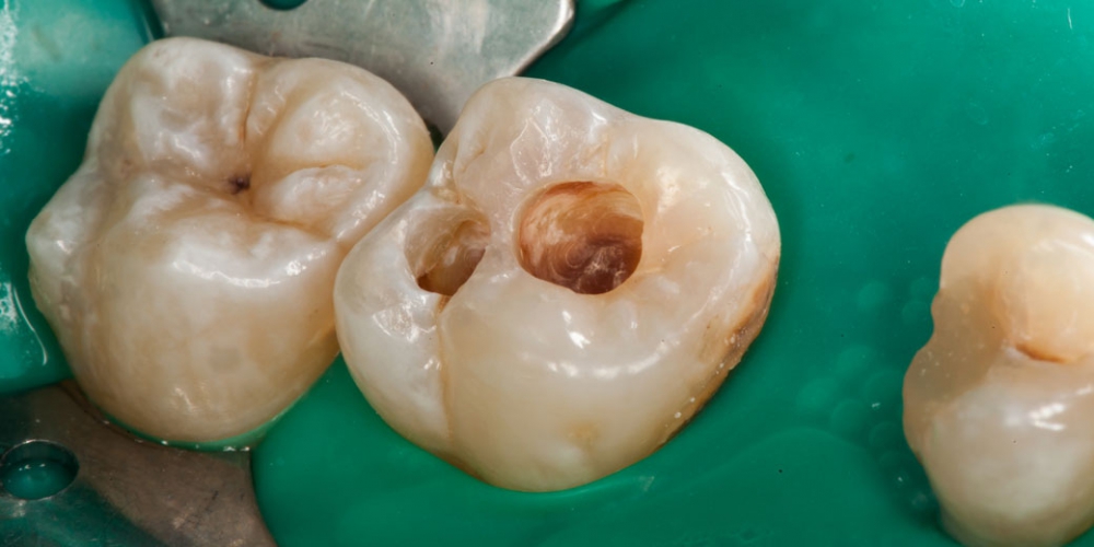  Результат лечения кариеса, реставрация жевательного зуба