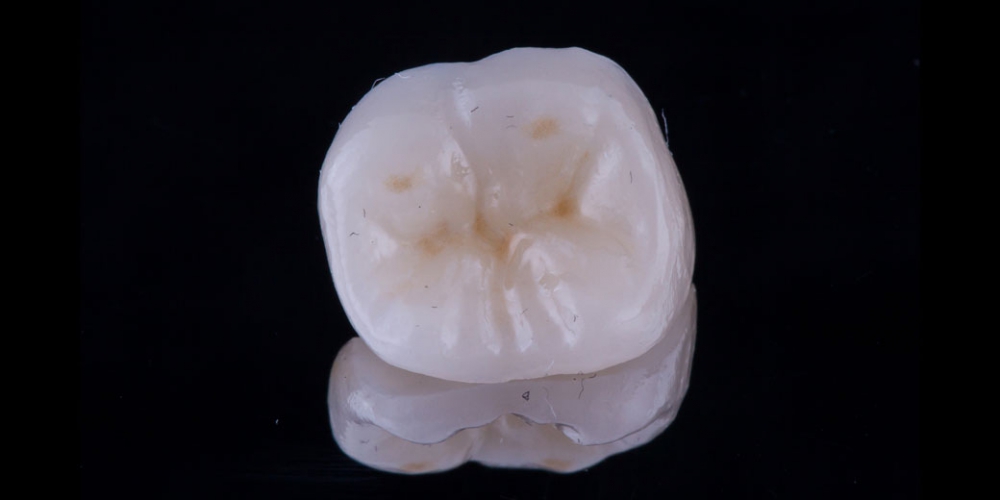 Керамическая вкладка-коронка Восстановление разрушенного зуба керамической полукоронкой