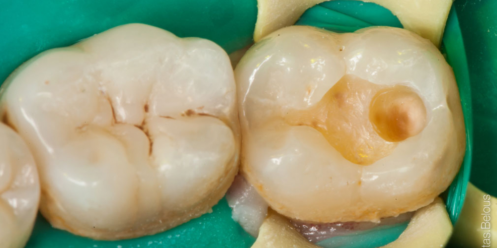  Лечение глубокого кариеса 36 и 37 зуба