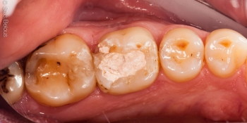 Восстановление разрушенного зуба керамической полукоронкой фото до лечения