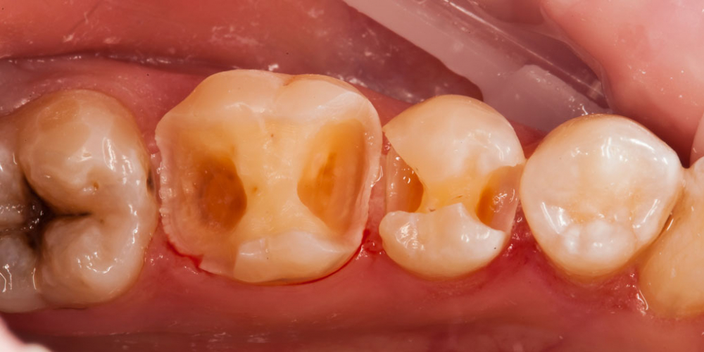  Начали лечение кариеса на одном зубе, а в итоге сделали - 2, цельнокерамическими вкладками