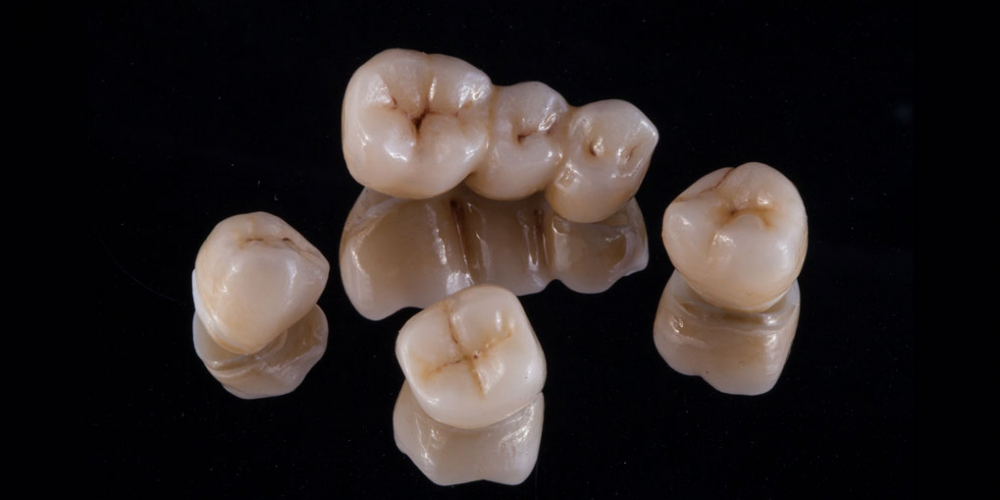  Протезирование зубов на имплантантах