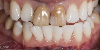 Временные реставрации по форме своих собственных зубов фото до лечения