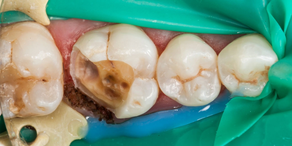 Подготовка зуба, удаление старой пломбы и удаление кариеса Восстановление разрушенного зуба керамической вкладкой