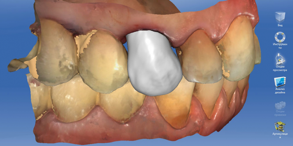  Восстановление утраченных тканей зуба коронкой Cerec