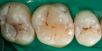 Пломба или реставрация зуба фото после лечения