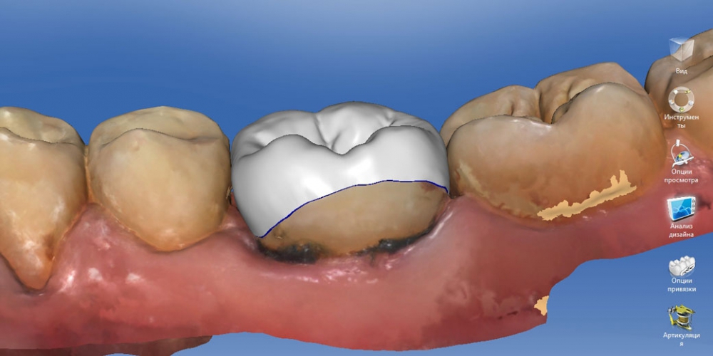 Процесс моделирования коронки с использованием профессиональных програм Восстановление зуба цельнокерамической коронкой смоделированной в 3D