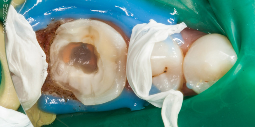  Восстановление отколотого зуба полукоронкой