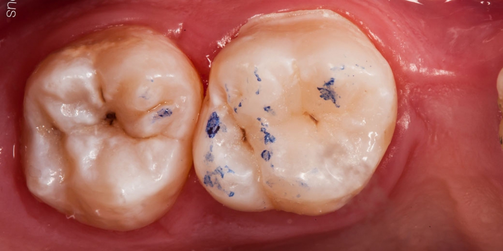 Проверка Результат лечения кариеса, реставрация жевательного зуба